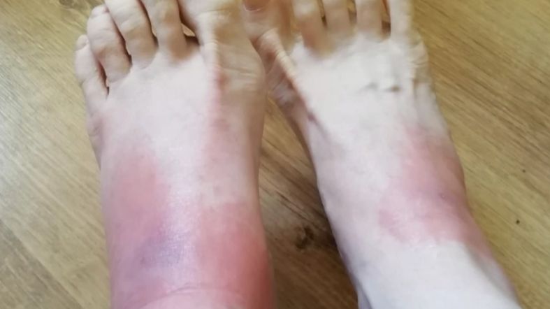 Wysypki skórne objawem COVID-19