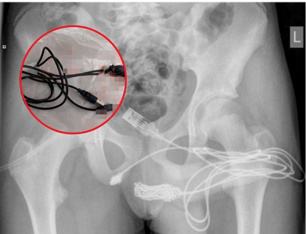 Nastolatek przeszedł operację, po tym jak wsadził kabel do swojego penisa