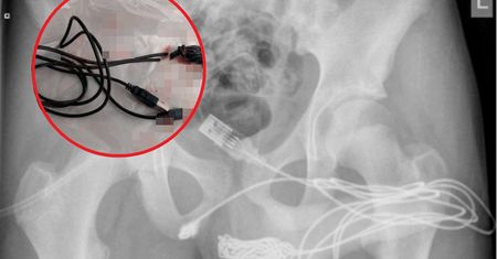 Miał kabel USB w cewce moczowej. Lekarze musieli wykonać operację, aby go usunąć