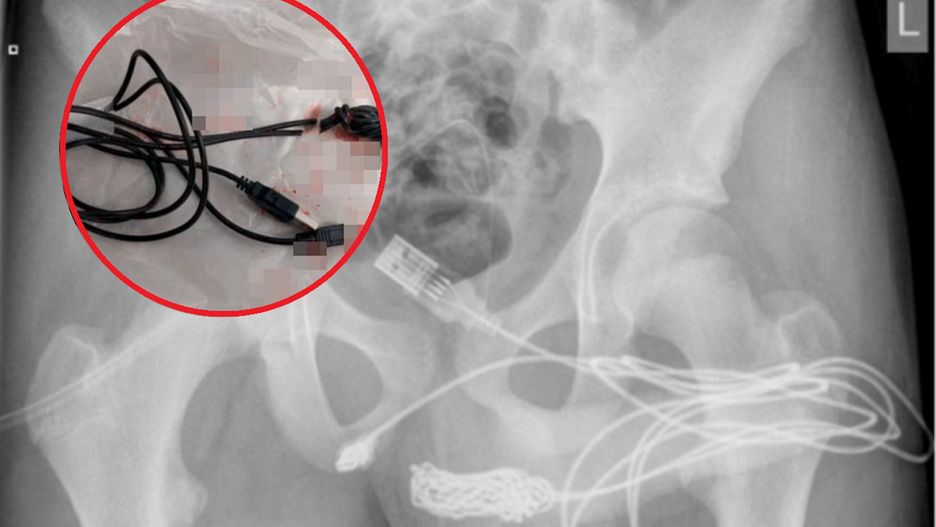 Nastolatek przeszedł operację, po tym jak wsadził kabel do swojego penisa