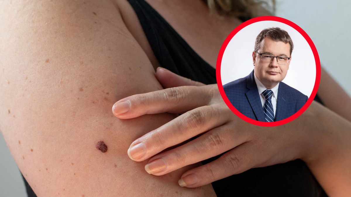 Takie zmiany powinny zaniepokoić. "Udajmy się do dermatologa"