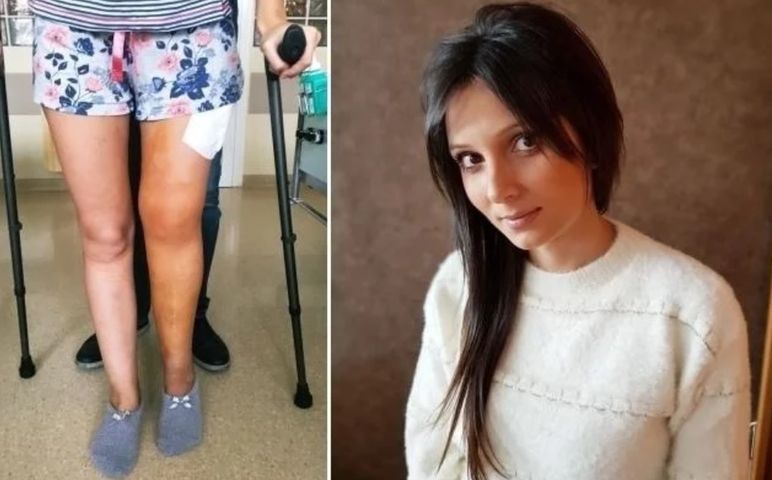 Agnieszka Kudyra błaga o pomoc. Zbiera środki na operację nogi, która pozwoli jej chodzić. 