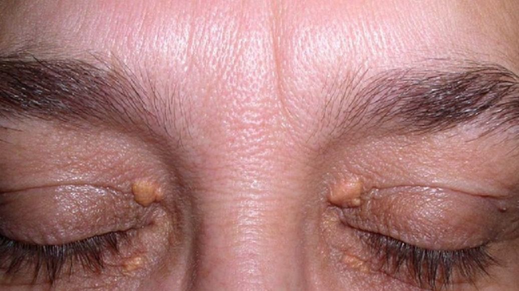 Zmiany na skórze mogą być sygnałem problemów z sercem. Nie lekceważ