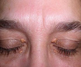 Zmiany na skórze mogą być sygnałem problemów z sercem. Nie lekceważ