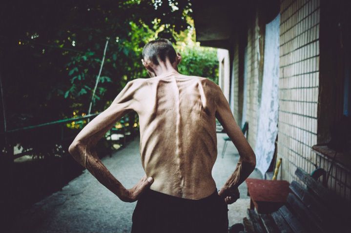 Epidemia gruźlicy na Ukrainie na zdjęciach Maxima Dondyuka 6