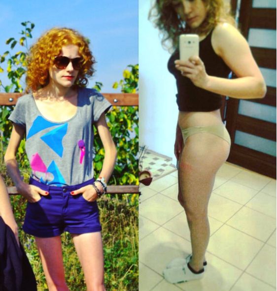 Karolina Dudek - w czasie i po walce z anoreksja
