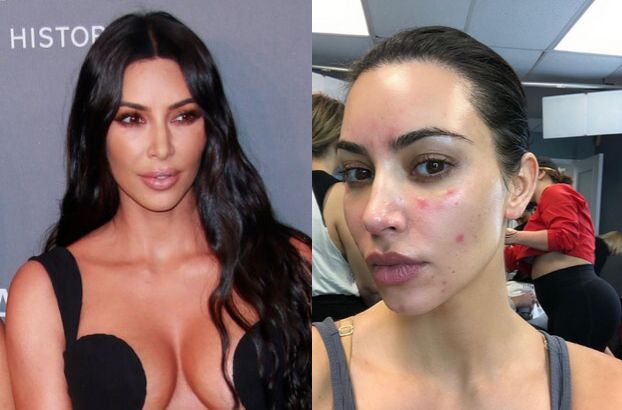 Kim Kardashian szczerze o walce z łuszczycą: "Ból był nie do zniesienia. Nie mogłam podnieść telefonu"