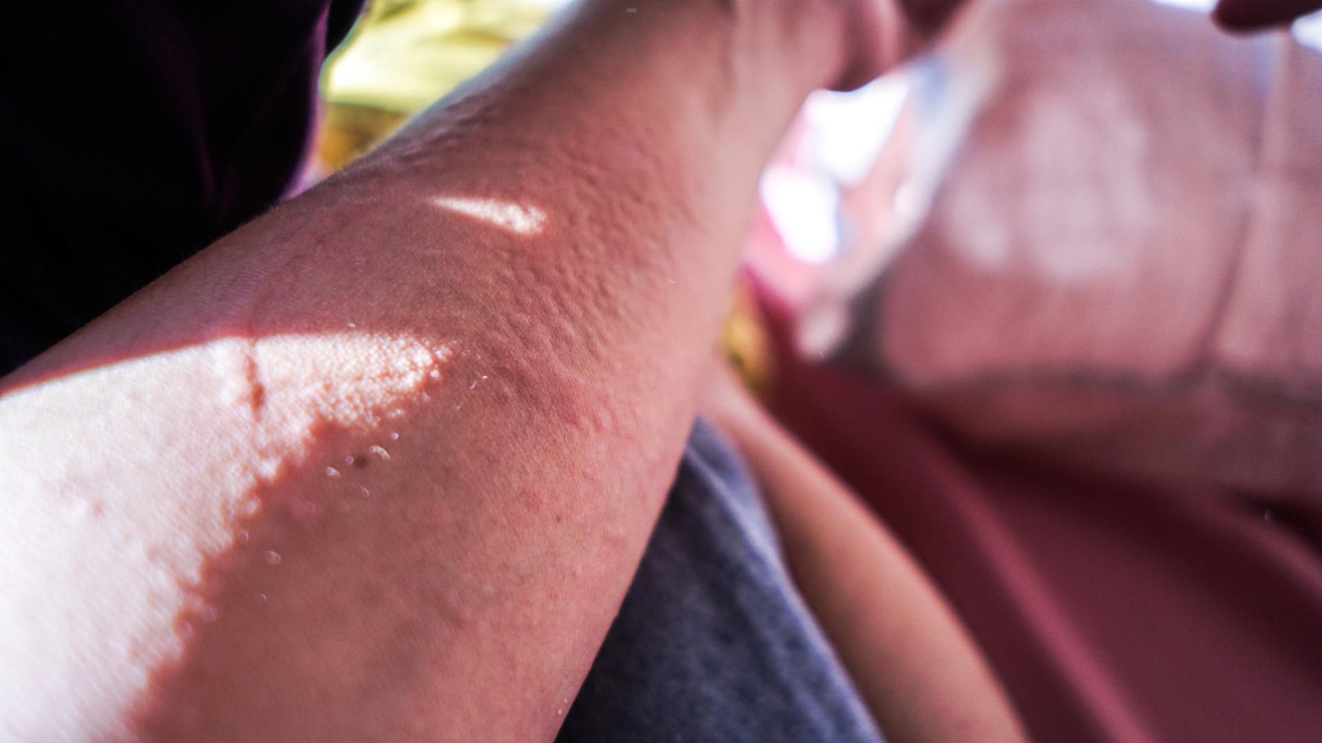 Na pokrzywkę &quot;wapno&quot; na pewno nie pomoże