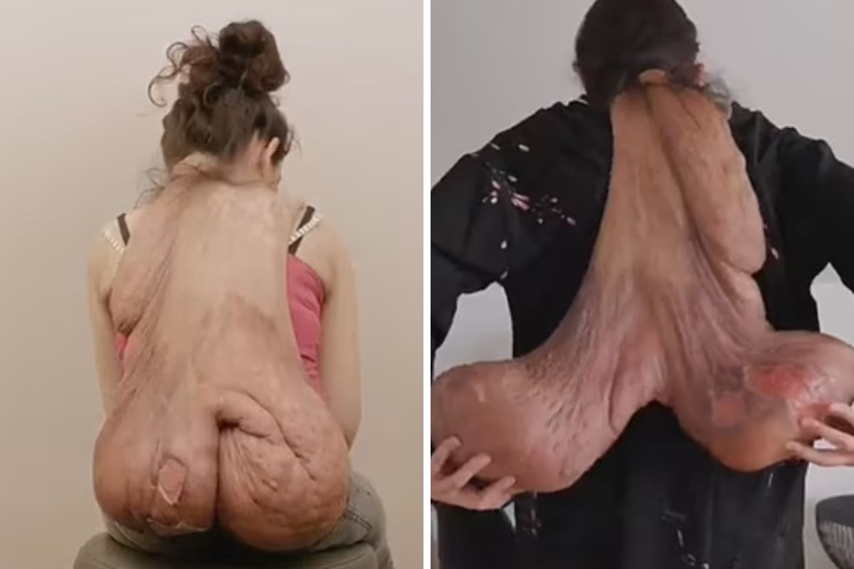 Guz ważył ok. dziesięciu kilogramów