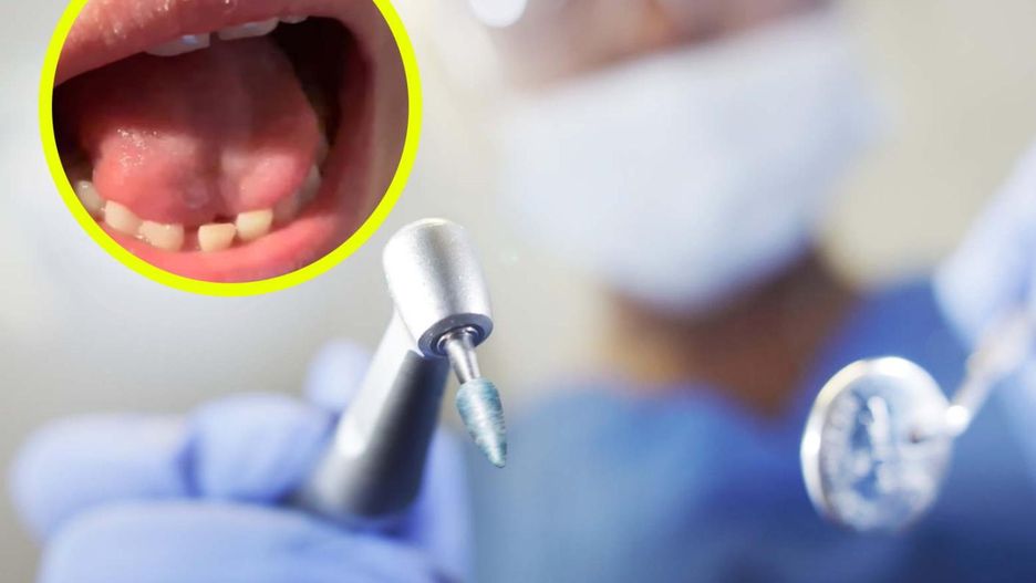 "Zęby rekina" – co to jest i czy trzeba się martwić?