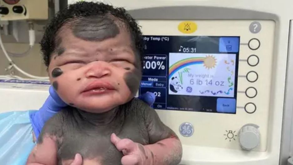 Dziewczynka "panda" wkrótce skończy 4 lata. Co u niej słychać?