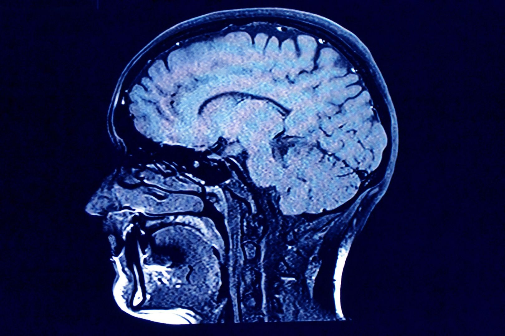 Zbadali wpływ COVID-19 na mózg. To, co odkryli, budzi lęk