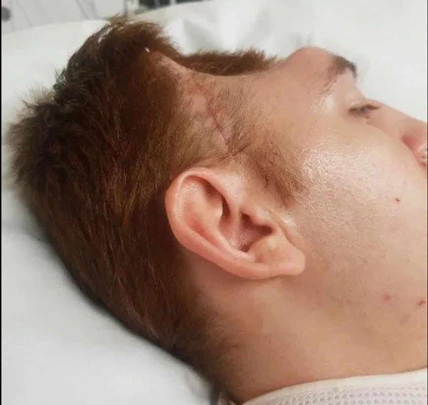 Opuchlizna mózgu sprawiła, że lekarze wycięli mu połowę czaszki. Skutki wypadku samochodowego