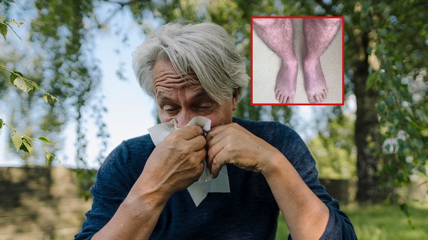 Rzadki objaw long COVID. Niebieskie nogi to sygnał problemów z sercem