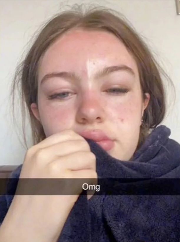 Opuchlizna po poparzeniu słonecznych pojawiła się na ustach i oczach kobiety