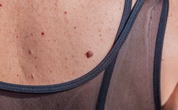 Widzisz na skórze "rubinki"? Ciało wysyła sygnał alarmowy