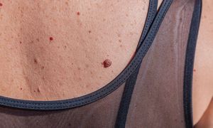 Na ciele pojawiły się "rubinki"? To może być znak ostrzegawczy