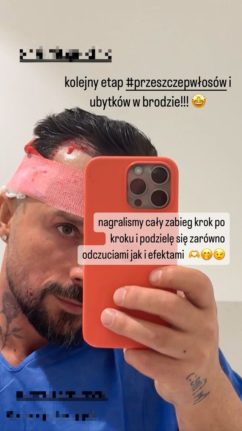 Qczaj zrelacjonował przeszczep włosów