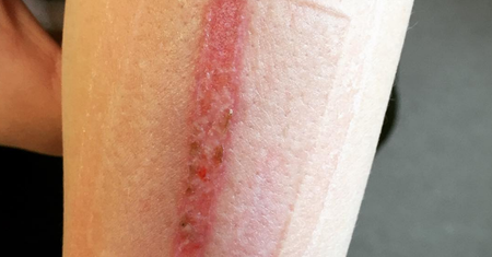 Eraser challenge: efekty wyzwania są przerażające, a mimo to chętnych nie brakuje