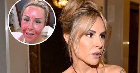 Blanka Lipińska nadawała cała we krwi: "Wyglądam jak taki kartofel"