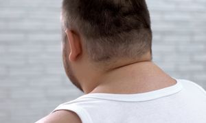 Bawoli kark. Jakie są jego przyczyny i jak się go pozbyć?