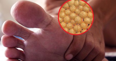 ''Cichy zabójca". Znak, że tętnice są zapchane cholesterolem