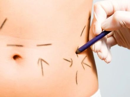 Liposukcja nie likwiduje trwale tkanki tłuszczowej