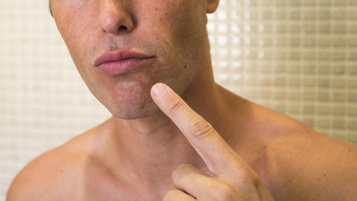 Opryszczkę można i trzeba leczyć. Przy niskiej odporności może być bardzo groźna