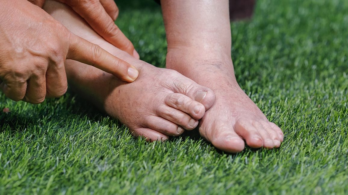 To dlatego puchną ci nogi i twarz. Najczęstszą przyczyną są błędy dietetyczne