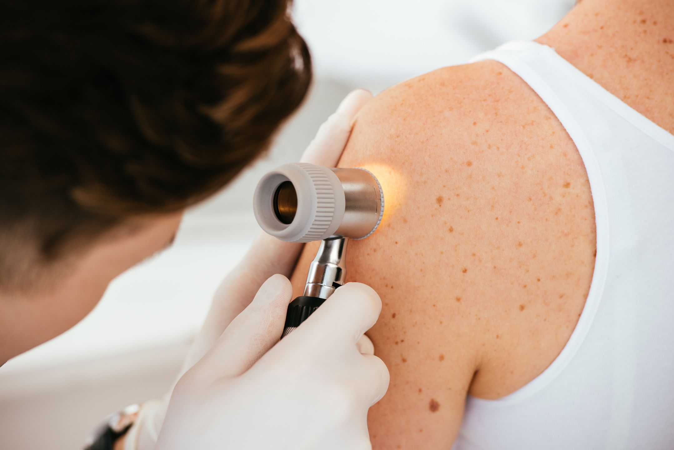dermatolog, rak, czerniak