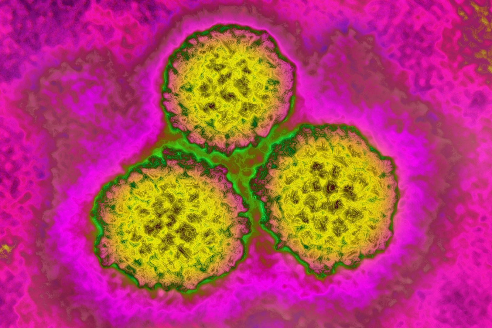 Wirus HPV, który wywołuje raka szyjki macicy, pod mikroskopem.