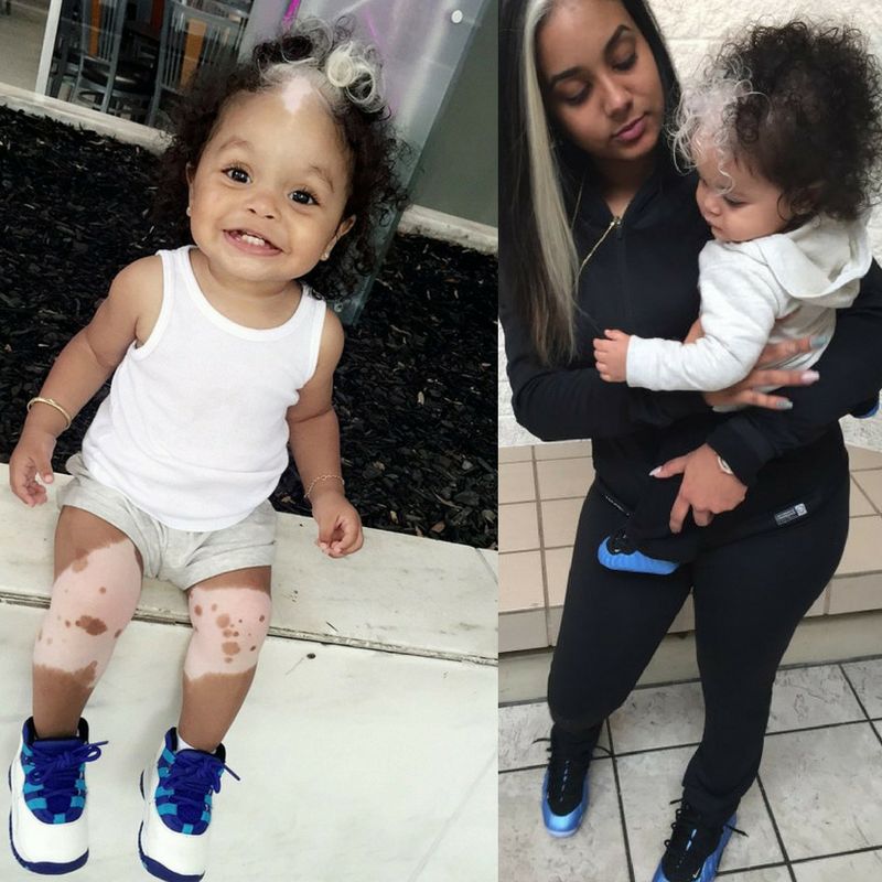 MilliAnna z bielactwem i jej mama/ DailyMail