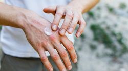 Suche dłonie - objawy, przyczyny i pielęgnacja skóry