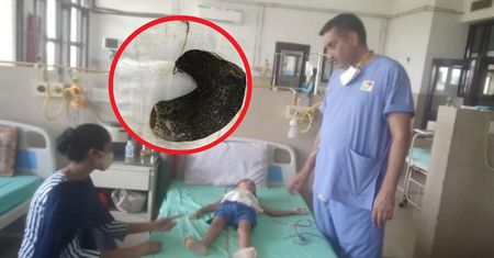 5-latka skarżyła się na ostry ból brzucha. Lekarze nie mogli uwierzyć, co się w nim znajdowało