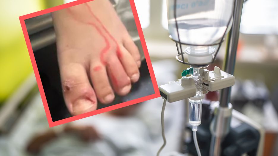 Gdyby nie czujność rodziców, mogłaby być konieczna amputacja