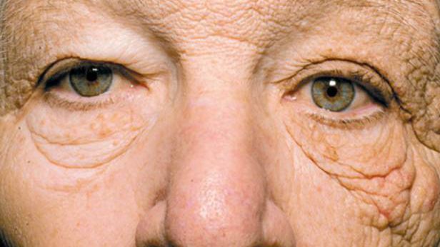 Pewien Grek przez pół życia wystawiał na słońce tylko połowę twarzy. Oto efekty 1