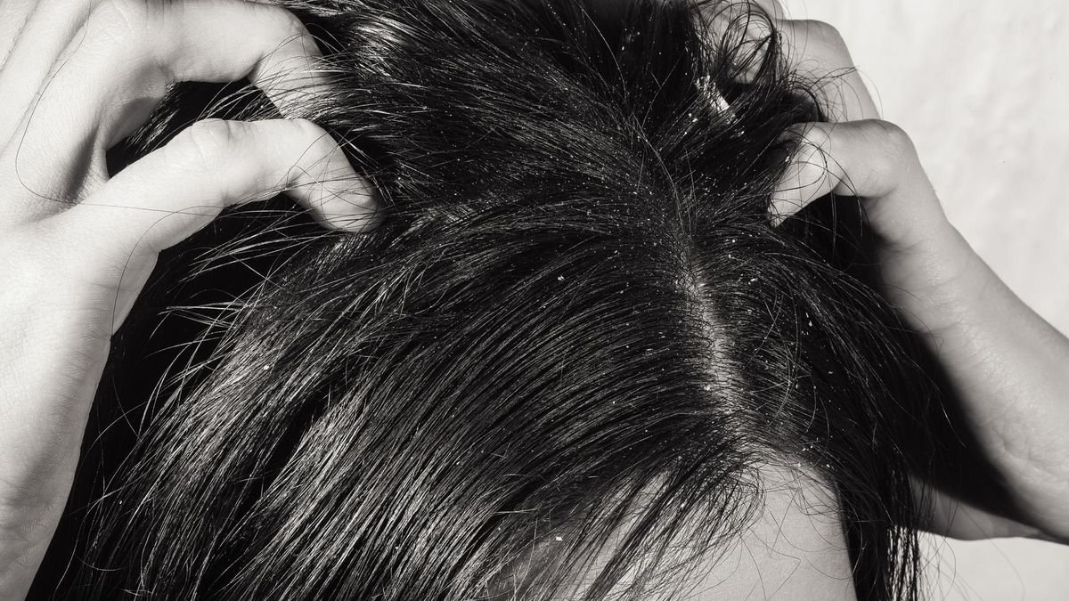 Przesuszony skalp to dziś częsty problem. 