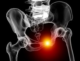 Złamanie kości łonowej – objawy, diagnostyka, leczenie i rehabilitacja