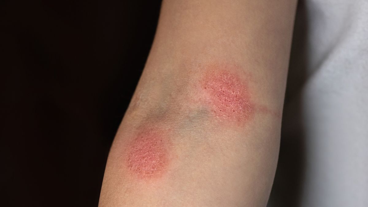 Grzybica skóry objawia się zmianami skórnymi