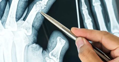 Przełom w radiologii. AI wykryje złamanie, które umknie ludzkiemu oku
