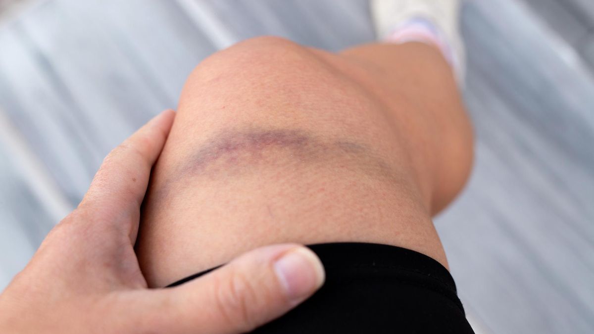 Objawem hemofilii może być pojawianie się licznych siniaków na skórze