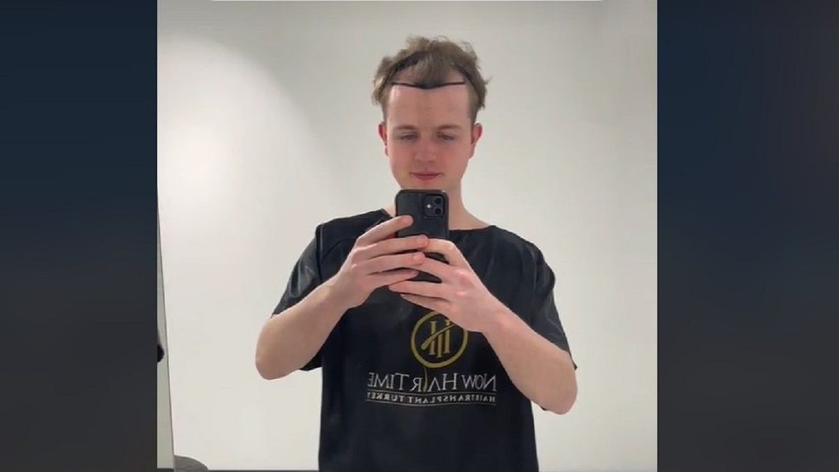 Pojechał do Turcji. Zrobił sobie tam przeszczep włosów. 