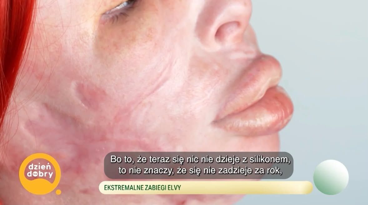 26-letnia Elva zdeformowała sobie twarz