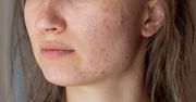 Pewnie robisz to za rzadko. Wtedy na twarzy pojawiają się wypryski