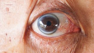 Szary pierścień wokół tęczówki. Co mówi o zdrowiu?