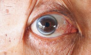 Szary pierścień wokół tęczówki. Co mówi o zdrowiu?