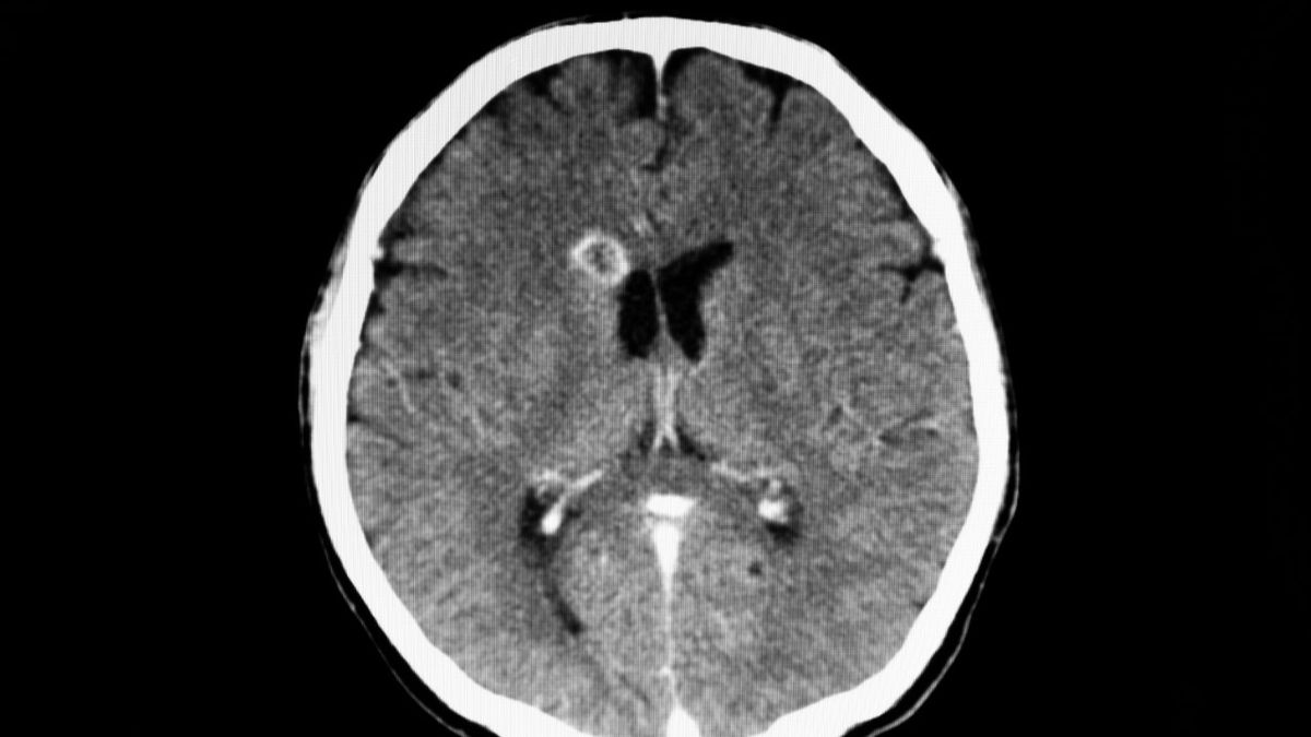 Ropień mózgu to ogniskowe zapalenie mózgu.