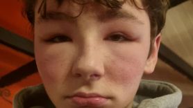 13-letni chłopiec trafił do szpitala z powodu reakcji alergicznej. Wywołał ją prezent świąteczny