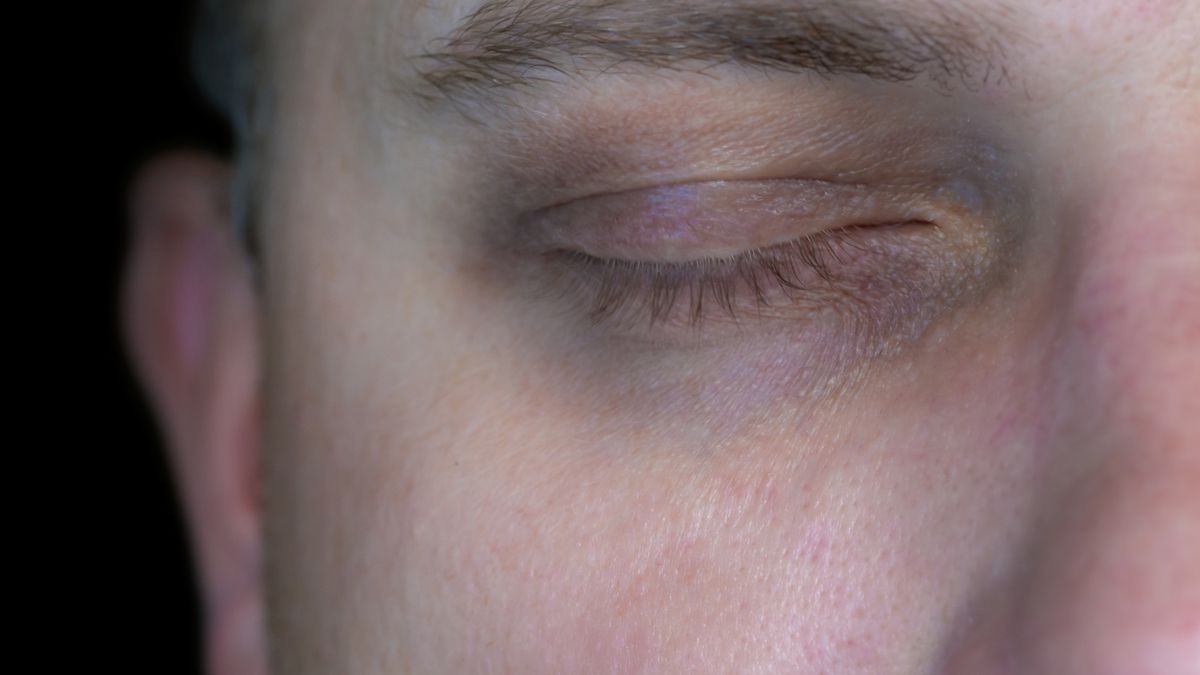 Zażółcona skóra to objaw raka trzustki