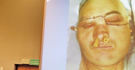 Przeszczep twarzy. Pierwsza taka operacja w Polsce to ogromny sukces